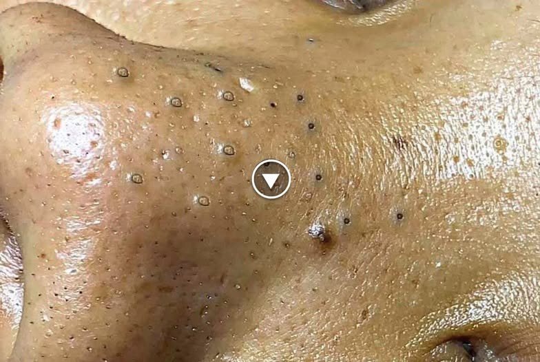 Blackhead Treatments